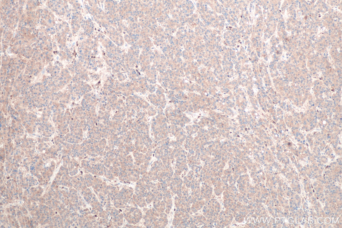 Immunohistochemical analysis of paraffin-embedded human liver cancer tissue slide using KHC0876 (G6PD IHC Kit).