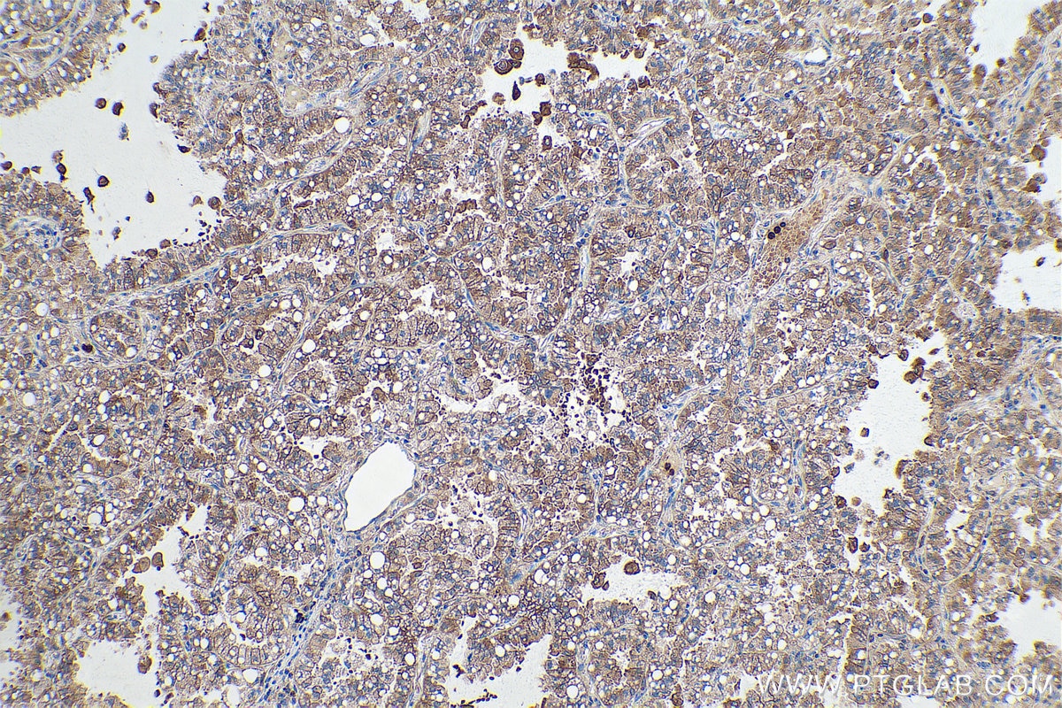 Immunohistochemical analysis of paraffin-embedded human lung cancer tissue slide using KHC0876 (G6PD IHC Kit).