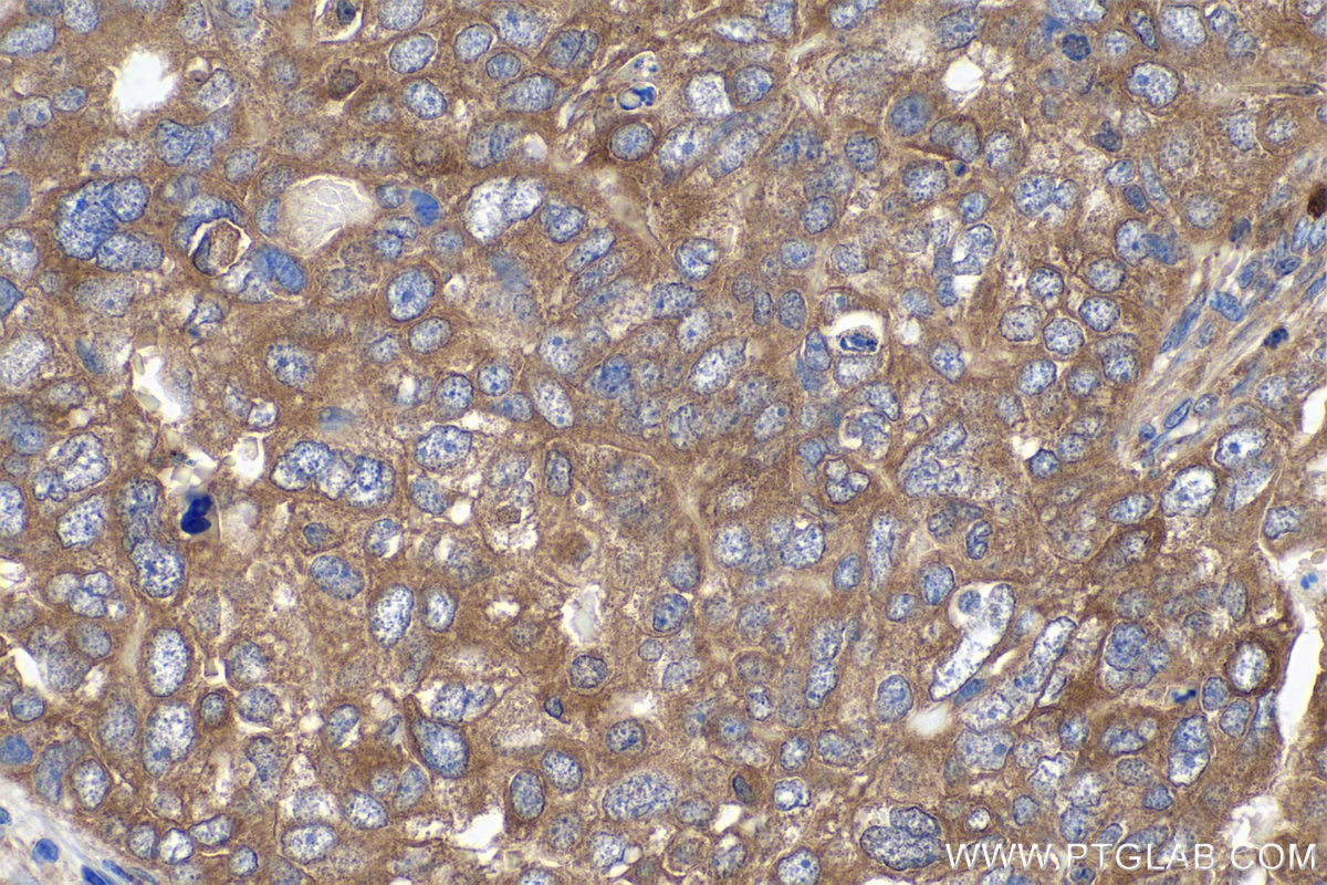 Immunohistochemical analysis of paraffin-embedded human ovary tumor tissue slide using KHC0876 (G6PD IHC Kit).