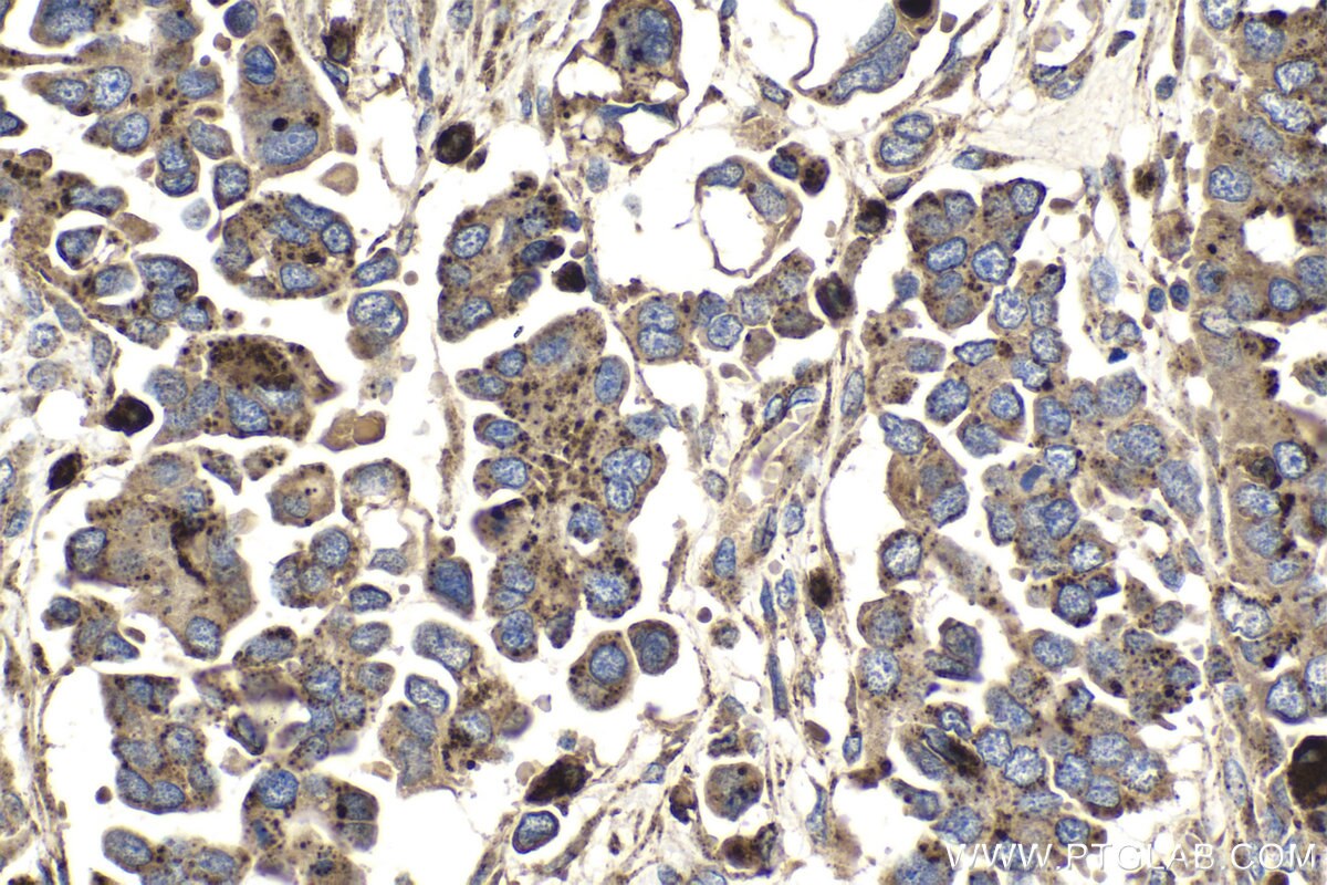 Immunohistochemical analysis of paraffin-embedded human colon cancer tissue slide using KHC0971 (GAA IHC Kit).