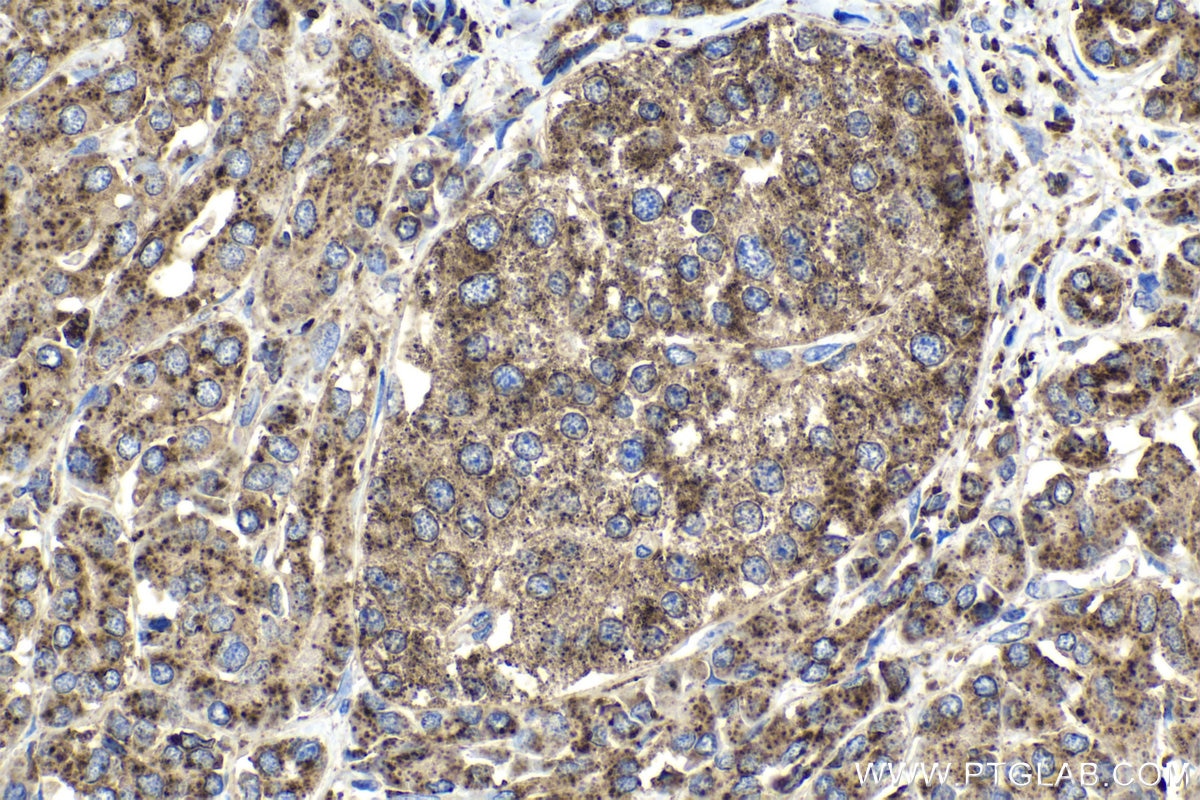 Immunohistochemical analysis of paraffin-embedded human pancreas cancer tissue slide using KHC0971 (GAA IHC Kit).