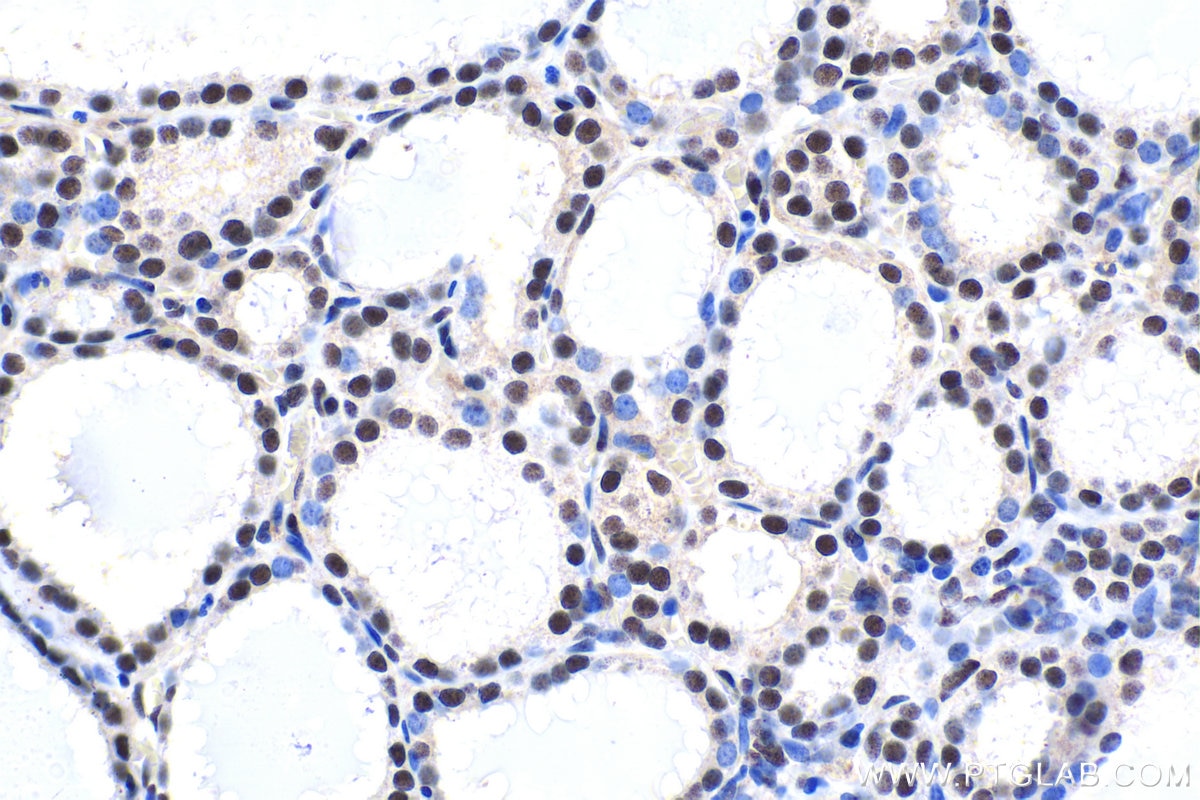 Immunohistochemical analysis of paraffin-embedded human thyroid cancer tissue slide using KHC1682 (GABPA IHC Kit).