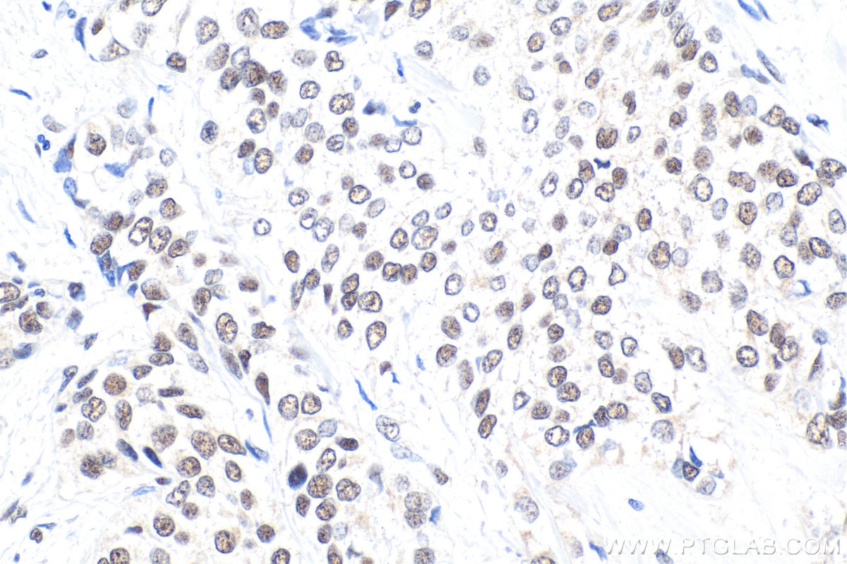 Immunohistochemical analysis of paraffin-embedded human urothelial carcinoma tissue slide using KHC1682 (GABPA IHC Kit).