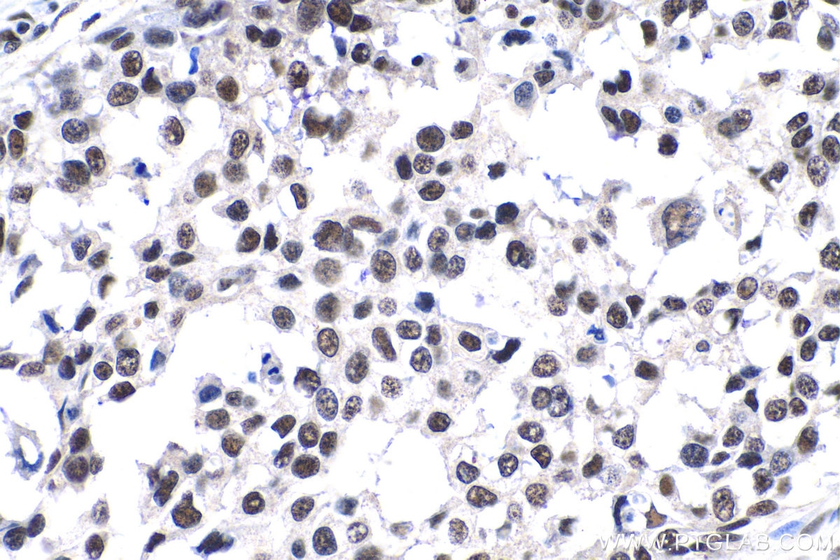 Immunohistochemical analysis of paraffin-embedded human breast cancer tissue slide using KHC1384 (GABPB1 IHC Kit).