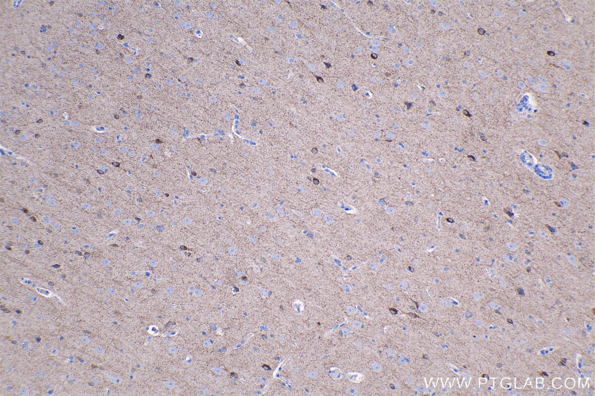 Immunohistochemical analysis of paraffin-embedded human gliomas tissue slide using KHC1339 (GAD1 IHC Kit).