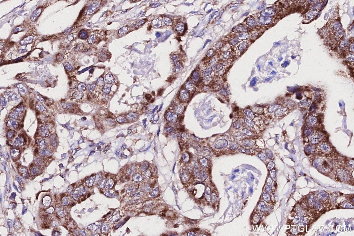 Immunohistochemical analysis of paraffin-embedded human stomach cancer tissue slide using KHC2704 (GADD45GIP1 IHC Kit).