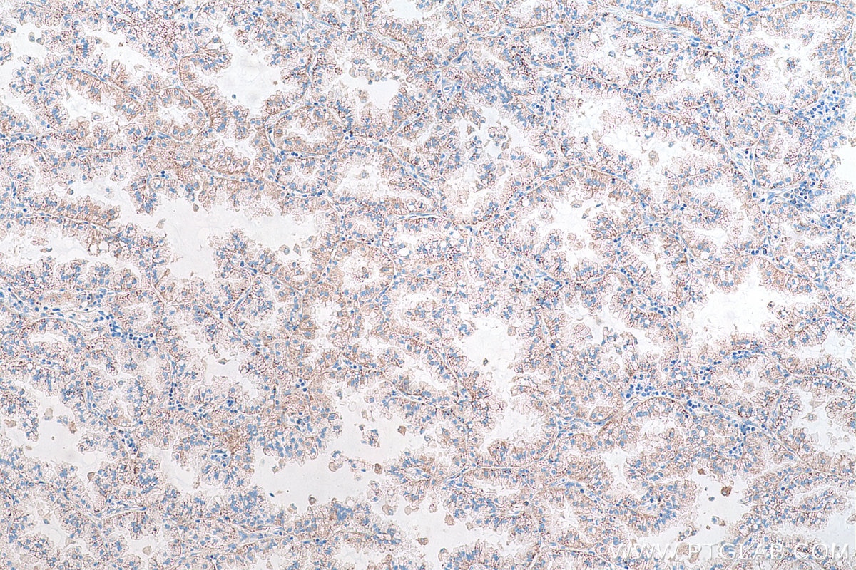 Immunohistochemical analysis of paraffin-embedded human lung cancer tissue slide using KHC0896 (GALK1 IHC Kit).