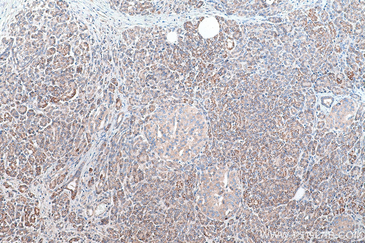 Immunohistochemical analysis of paraffin-embedded human pancreas cancer tissue slide using KHC0896 (GALK1 IHC Kit).
