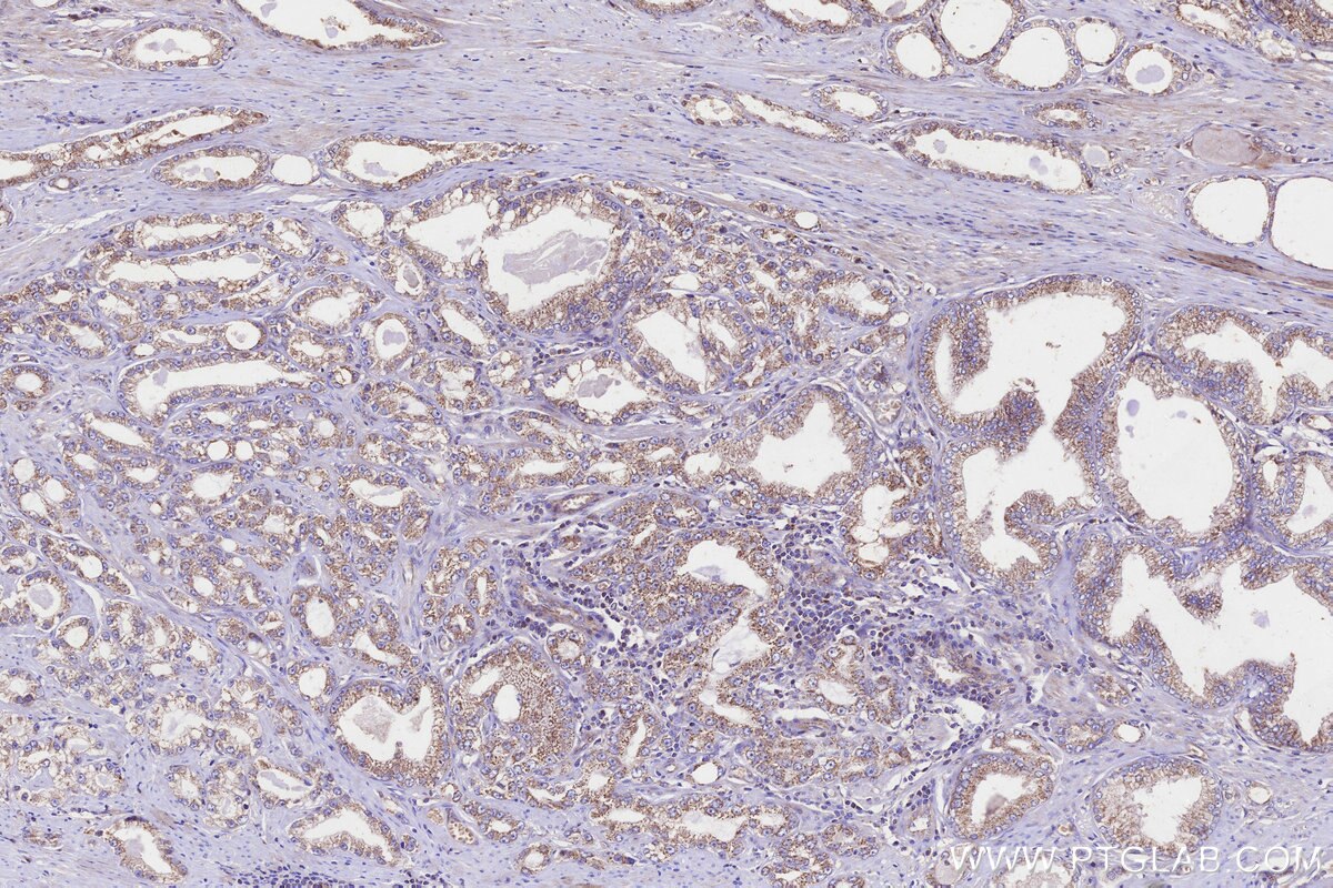 Immunohistochemical analysis of paraffin-embedded human prostate cancer tissue slide using KHC3270 (GALNT17/WBSCR17 IHC Kit).