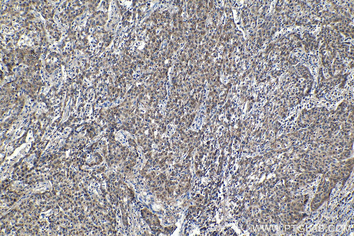 Immunohistochemical analysis of paraffin-embedded human cervical cancer tissue slide using KHC1226 (GALNT2 IHC Kit).