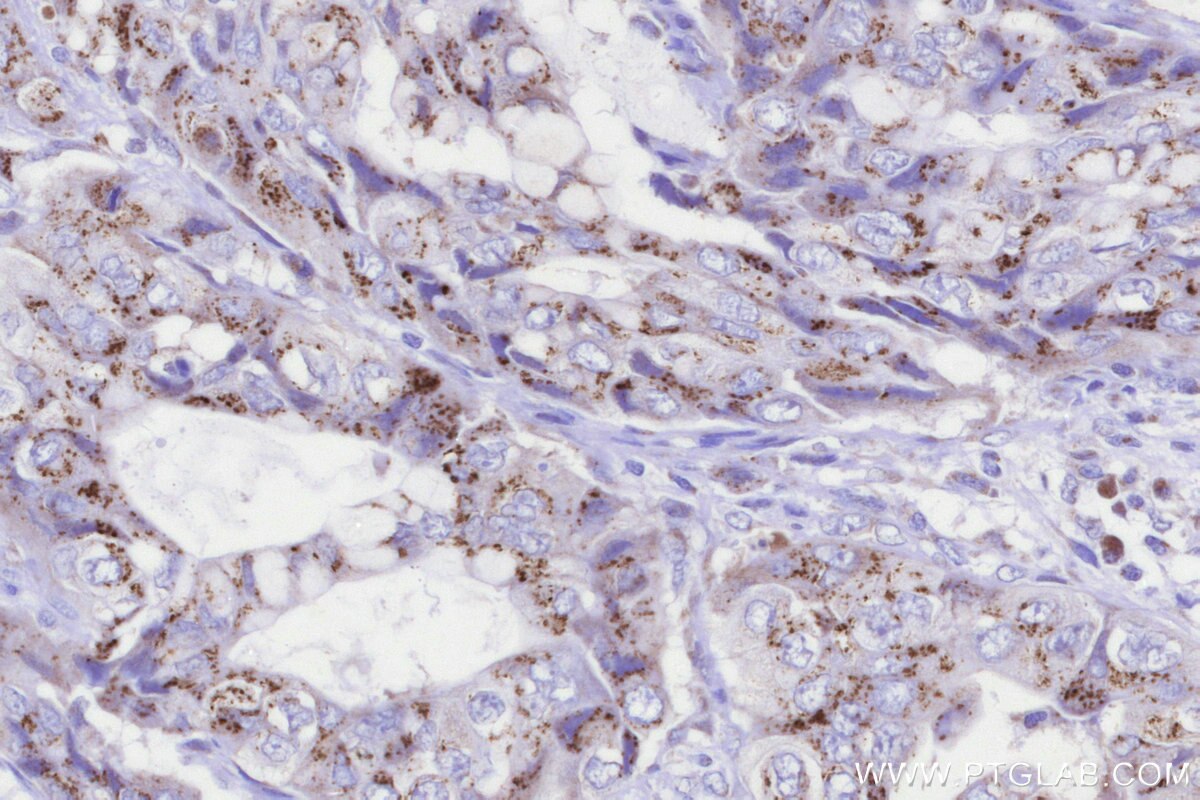 Immunohistochemical analysis of paraffin-embedded human pancreas cancer tissue slide using KHC3288 (GALNT4 IHC Kit). Immunohistochemical analysis of paraffin-embedded human pancreas cancer tissue slide using KHC3288 (GALNT4 IHC Kit).