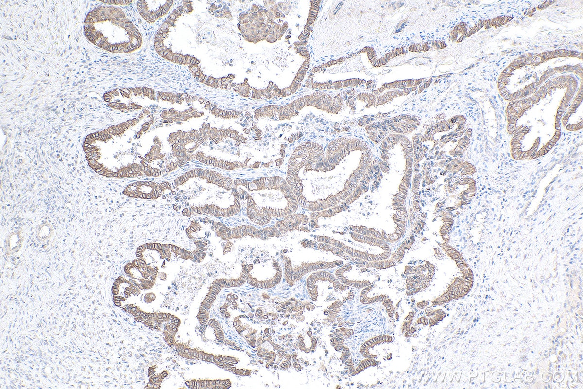 Immunohistochemical analysis of paraffin-embedded human ovary tumor tissue slide using KHC0810 (GALR2 IHC Kit).