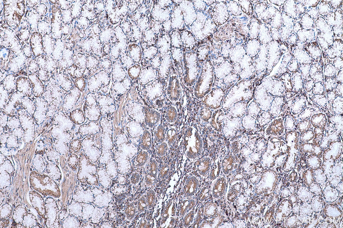 Immunohistochemical analysis of paraffin-embedded human stomach cancer tissue slide using KHC0666 (GANAB IHC Kit).
