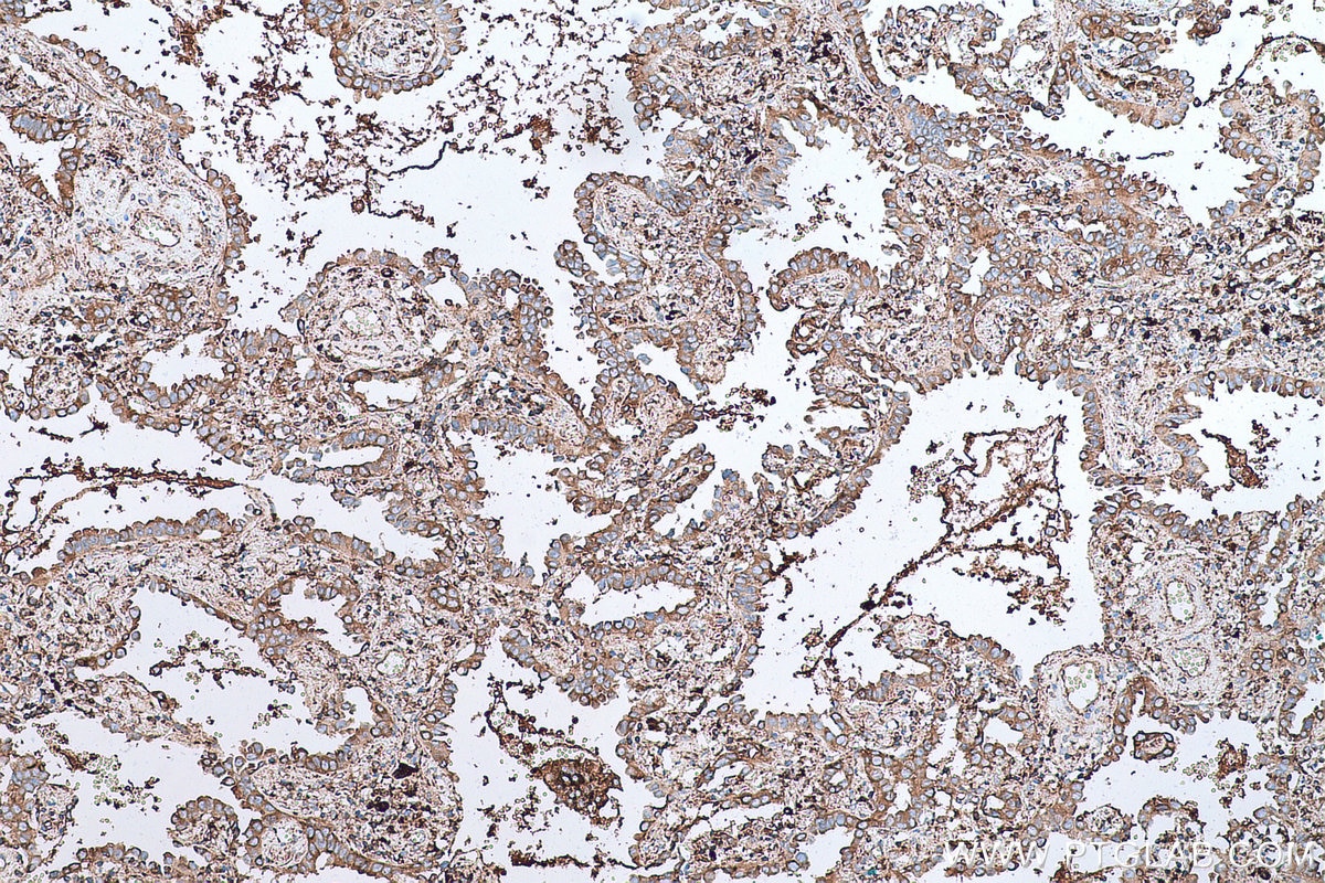 Immunohistochemical analysis of paraffin-embedded human lung cancer tissue slide using KHC0666 (GANAB IHC Kit).
