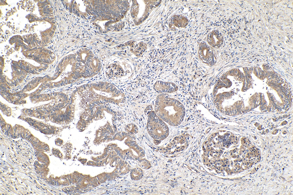 Immunohistochemical analysis of paraffin-embedded human pancreas cancer tissue slide using KHC1464 (GANP IHC Kit).