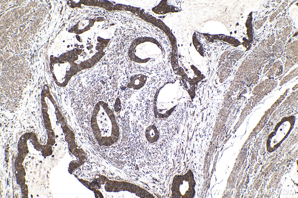 Immunohistochemical analysis of paraffin-embedded human urothelial carcinoma tissue slide using KHC1464 (GANP IHC Kit).
