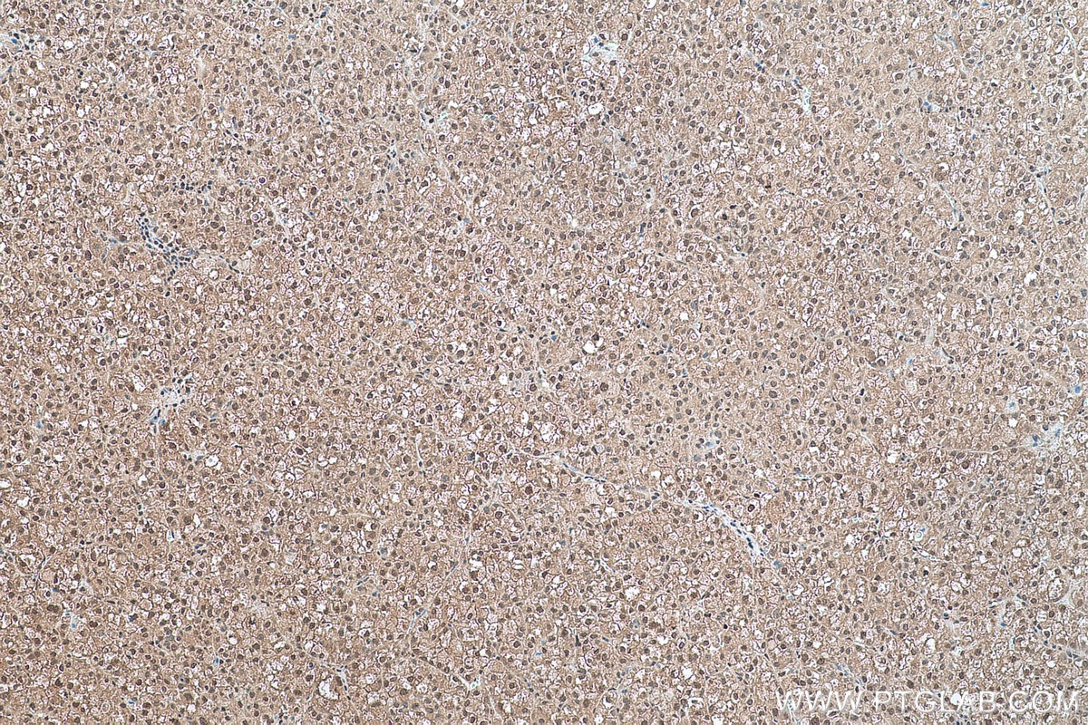 Immunohistochemical analysis of paraffin-embedded human liver cancer tissue slide using KHC0501 (GAPDH IHC Kit).