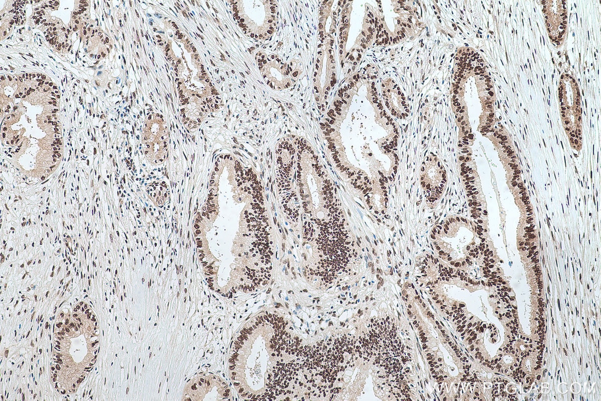 Immunohistochemical analysis of paraffin-embedded human pancreas cancer tissue slide using KHC0501 (GAPDH IHC Kit).