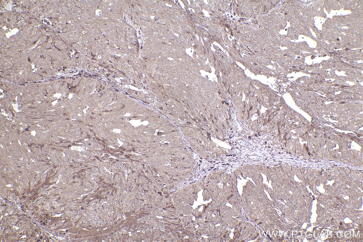 Immunohistochemical analysis of paraffin-embedded human ovary cancer tissue slide using KHC2472 (GAPVD1 IHC Kit).