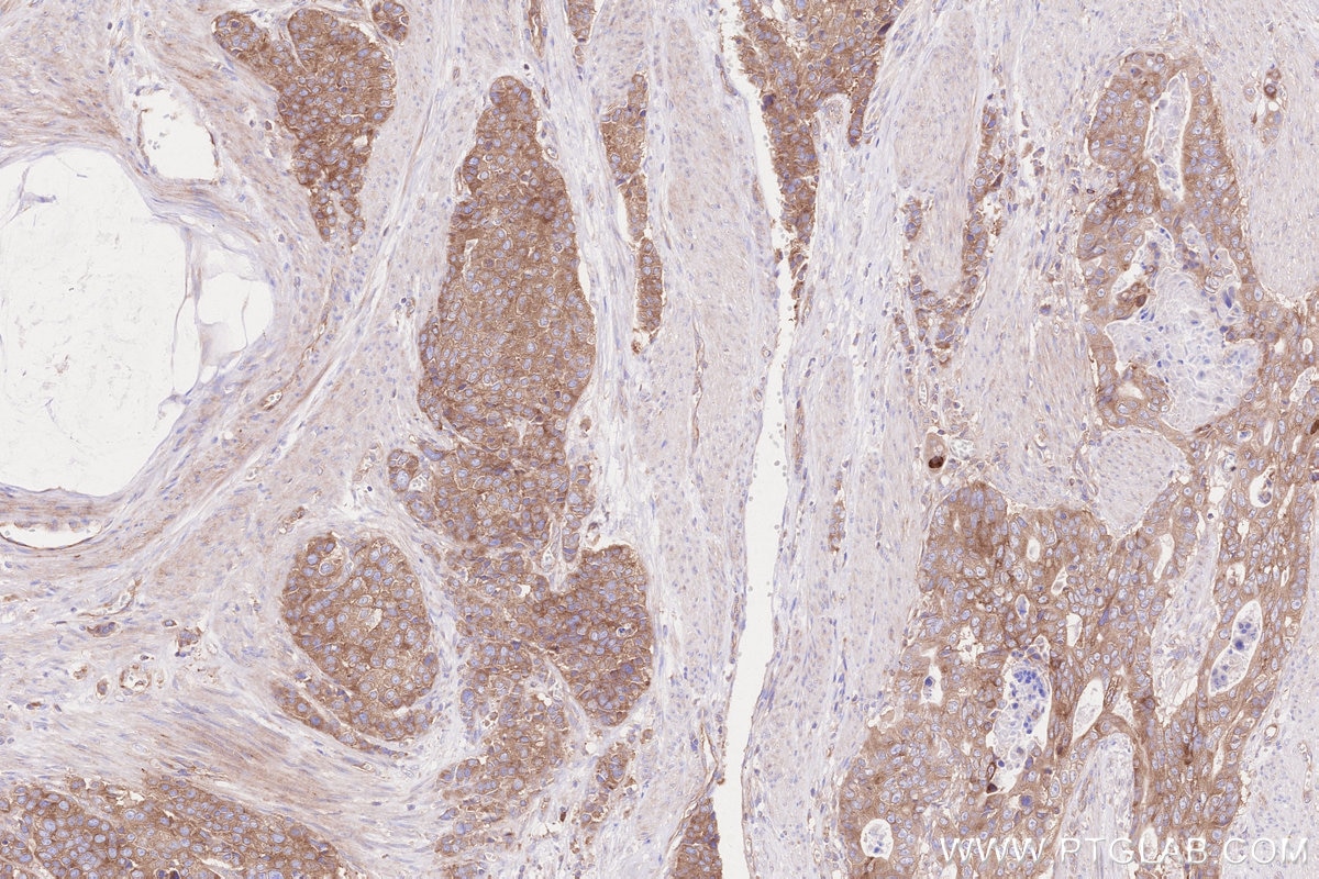 Immunohistochemical analysis of paraffin-embedded human stomach cancer tissue slide using KHC2576 (GARNL1 IHC Kit).