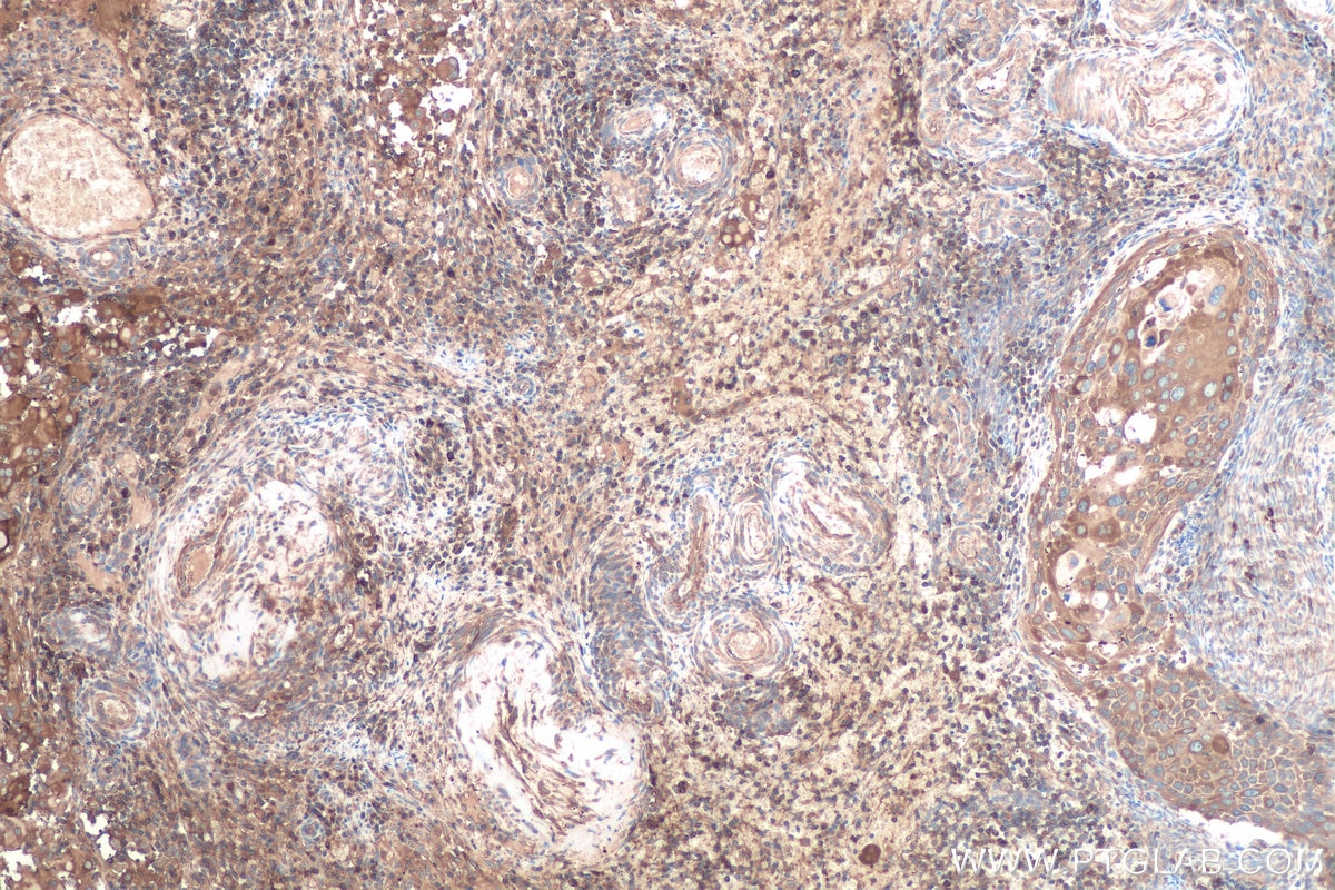 Immunohistochemical analysis of paraffin-embedded human cervical cancer tissue slide using KHC0879 (GARS IHC Kit).