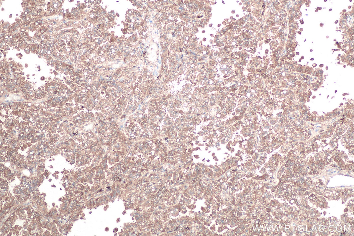 Immunohistochemical analysis of paraffin-embedded human lung cancer tissue slide using KHC0879 (GARS IHC Kit).