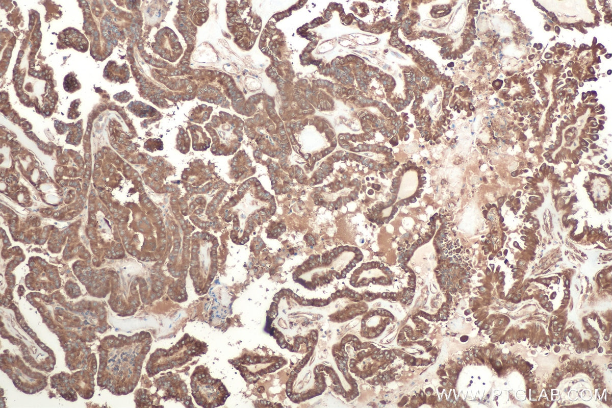 Immunohistochemical analysis of paraffin-embedded human thyroid cancer tissue slide using KHC0879 (GARS IHC Kit).