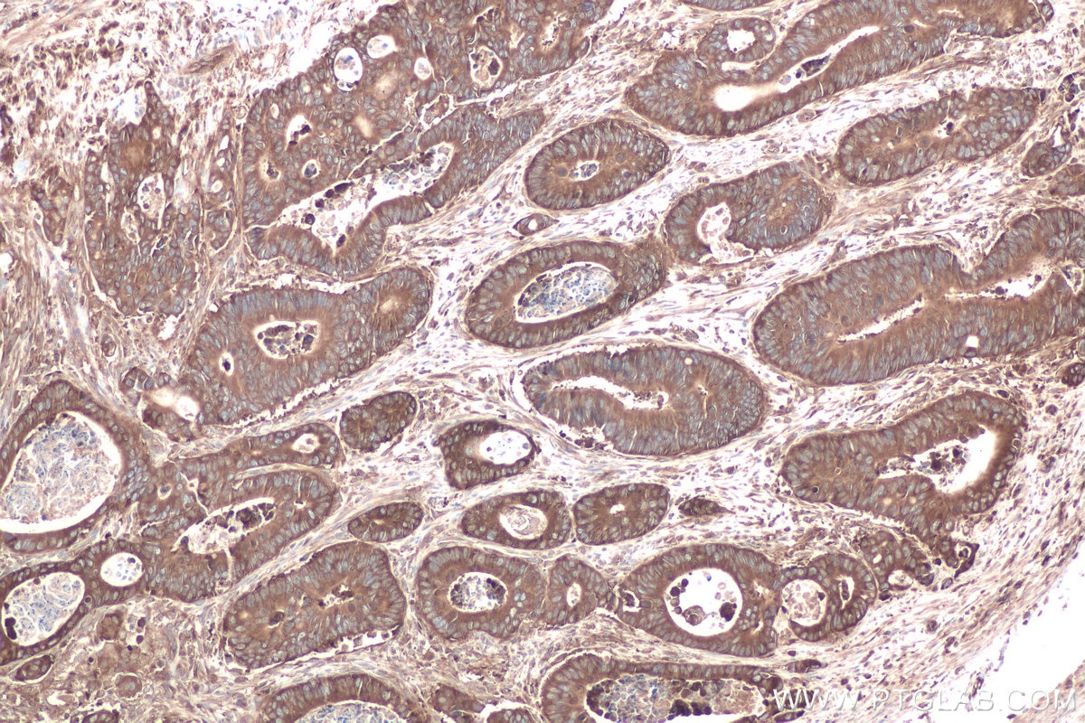 Immunohistochemical analysis of paraffin-embedded human colon cancer tissue slide using KHC0879 (GARS IHC Kit).