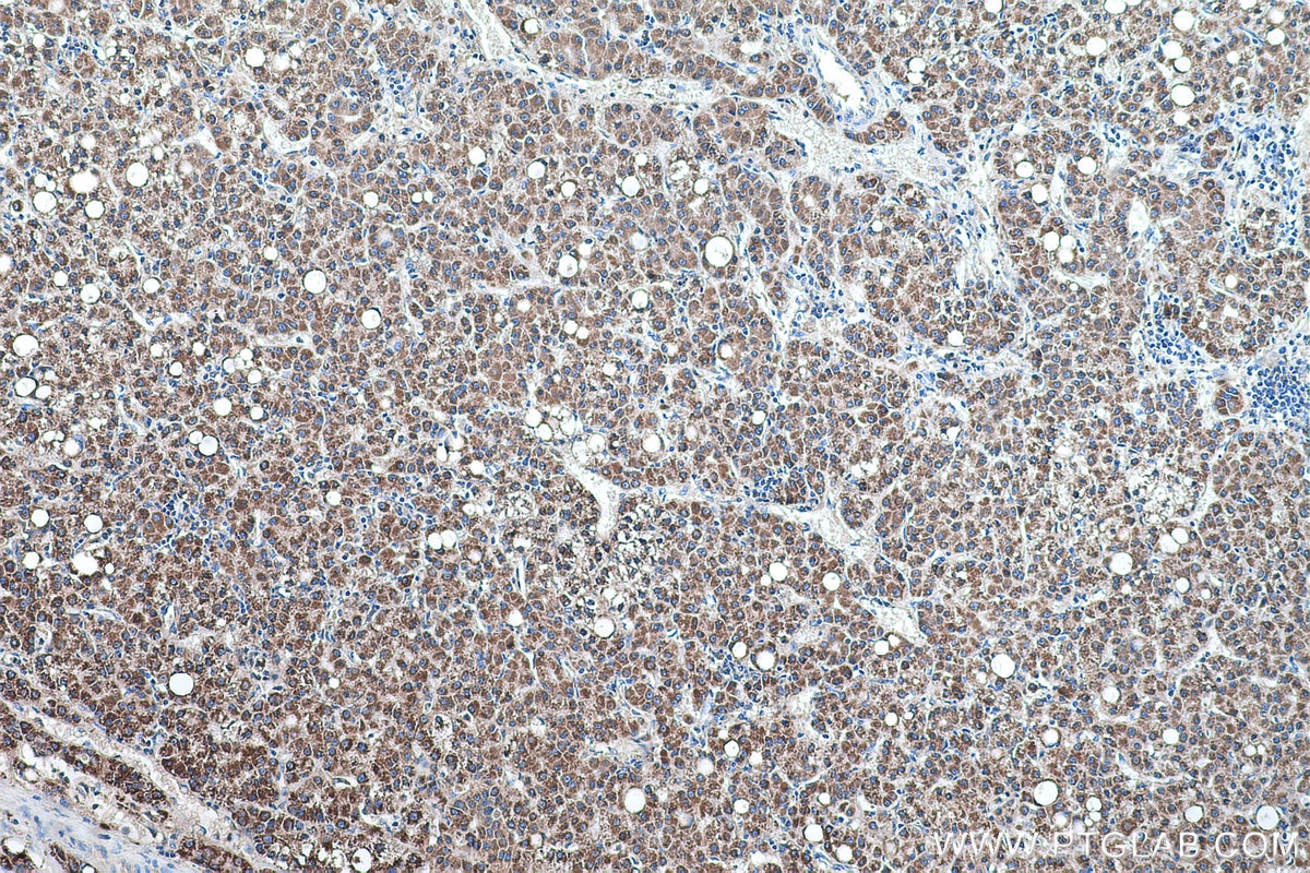 Immunohistochemical analysis of paraffin-embedded human liver cancer tissue slide using KHC0560 (GATM IHC Kit).