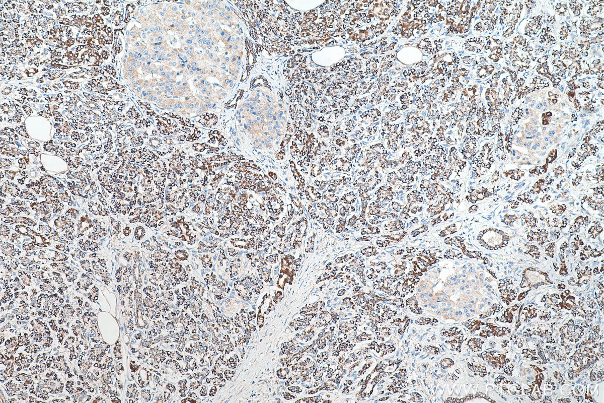 Immunohistochemical analysis of paraffin-embedded human pancreas cancer tissue slide using KHC0560 (GATM IHC Kit).