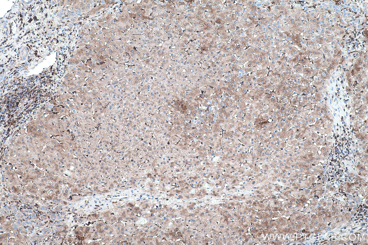 Immunohistochemical analysis of paraffin-embedded human liver cancer tissue slide using KHC0421 (GBP1 IHC Kit).