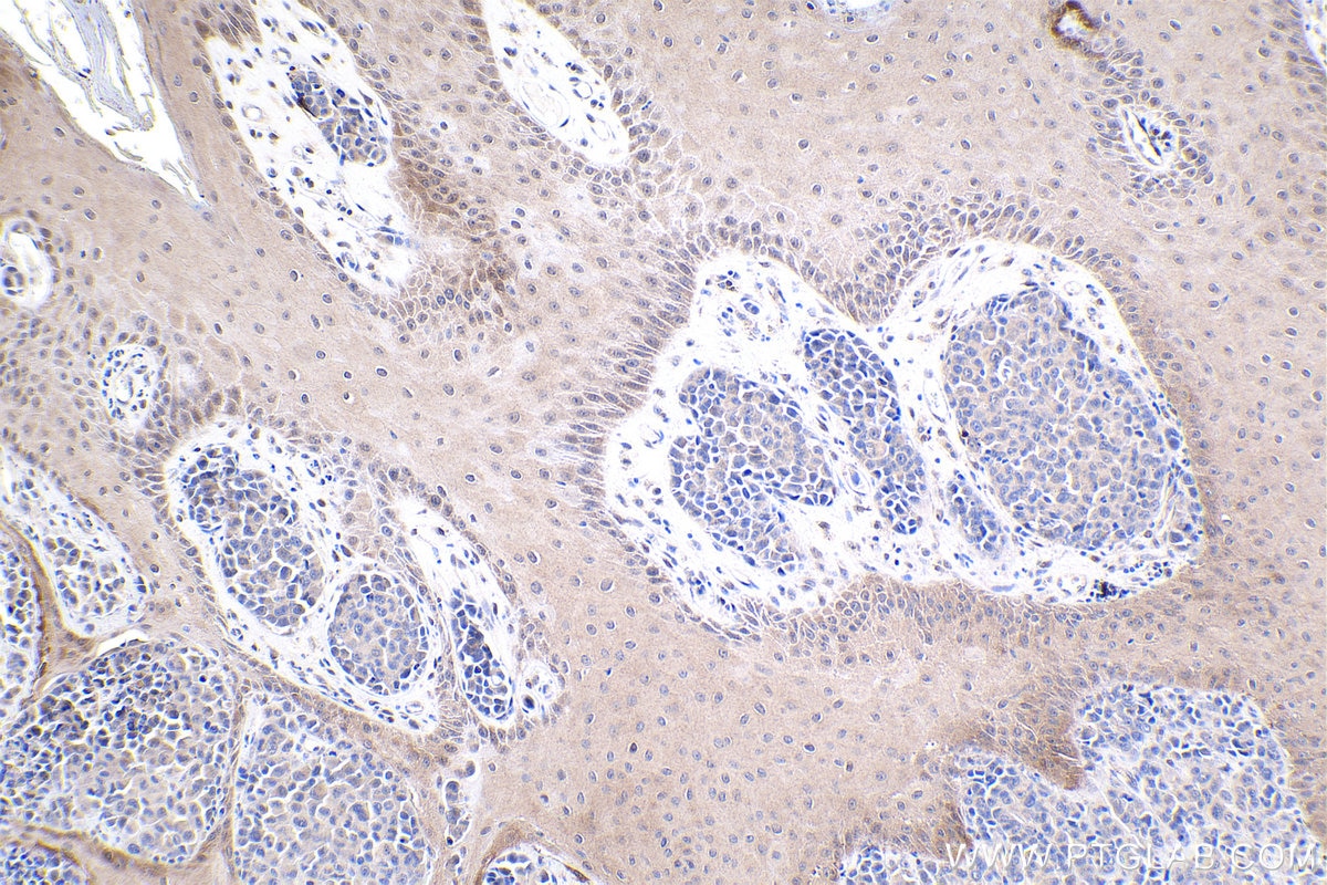 Immunohistochemical analysis of paraffin-embedded human malignant melanoma tissue slide using KHC1921 (GBP3 IHC Kit).