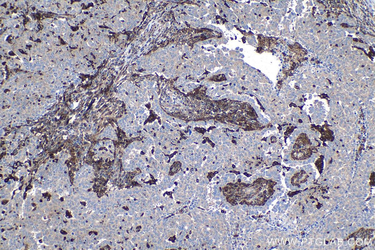 Immunohistochemical analysis of paraffin-embedded human ovary tumor tissue slide using KHC1311 (GBP5 IHC Kit).