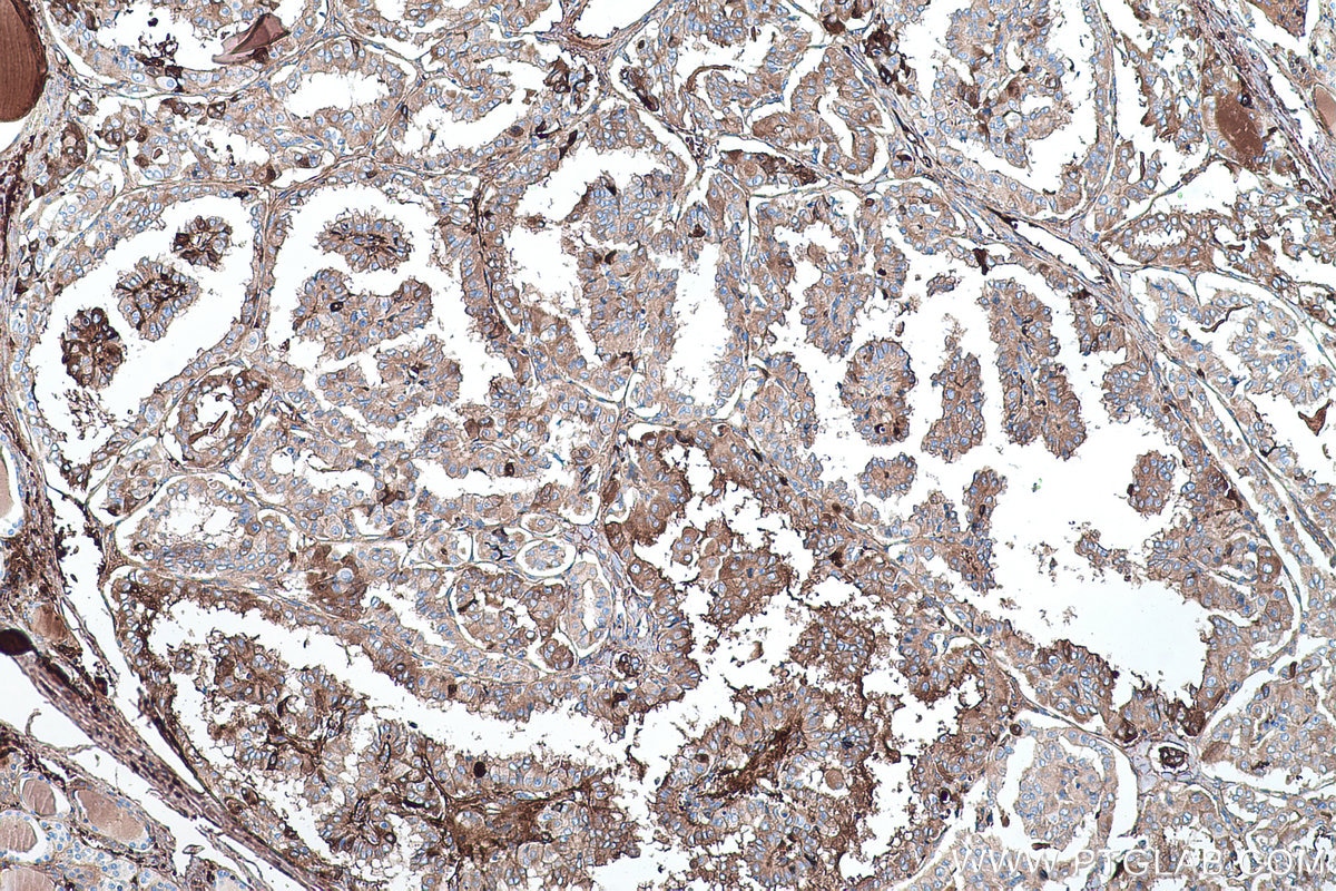 Immunohistochemical analysis of paraffin-embedded human thyroid cancer tissue slide using KHC0422 (GC/VTDB IHC Kit).