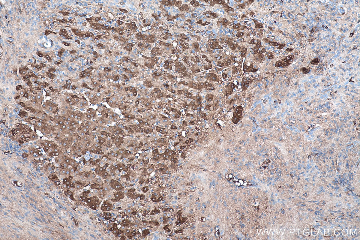 Immunohistochemical analysis of paraffin-embedded human liver cancer tissue slide using KHC0422 (GC/VTDB IHC Kit).
