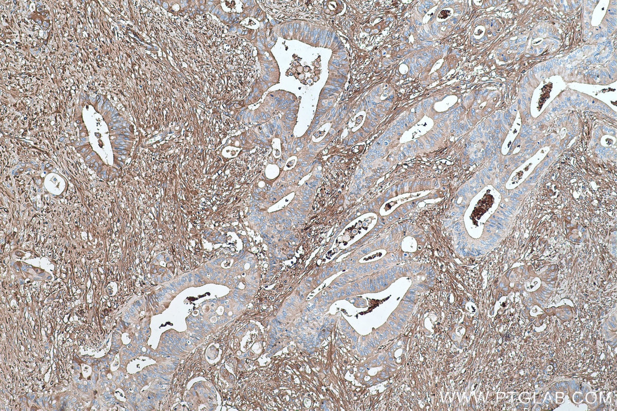 Immunohistochemical analysis of paraffin-embedded human colon cancer tissue slide using KHC0422 (GC/VTDB IHC Kit).