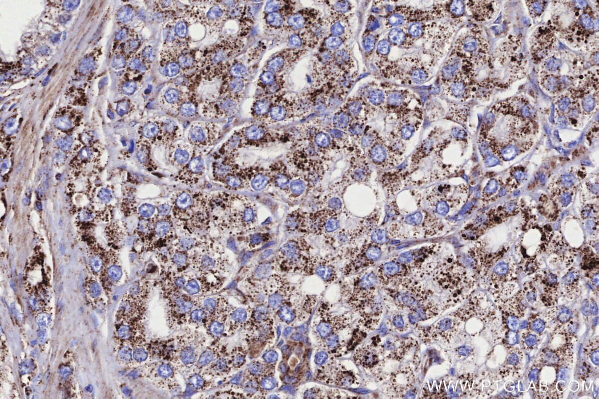 Immunohistochemical analysis of paraffin-embedded human prostate cancer tissue slide using KHC3309 (GCDH IHC Kit).