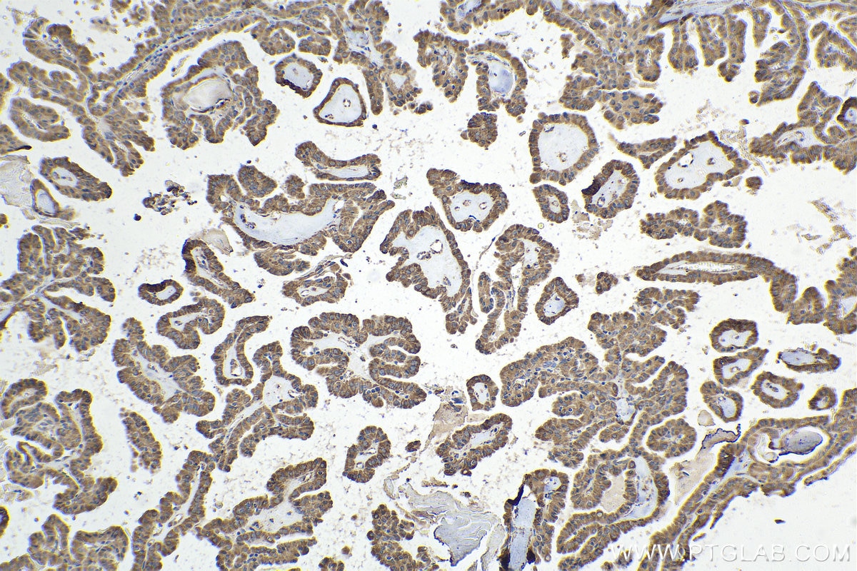 Immunohistochemical analysis of paraffin-embedded human thyroid cancer tissue slide using KHC1584 (GCK IHC Kit).