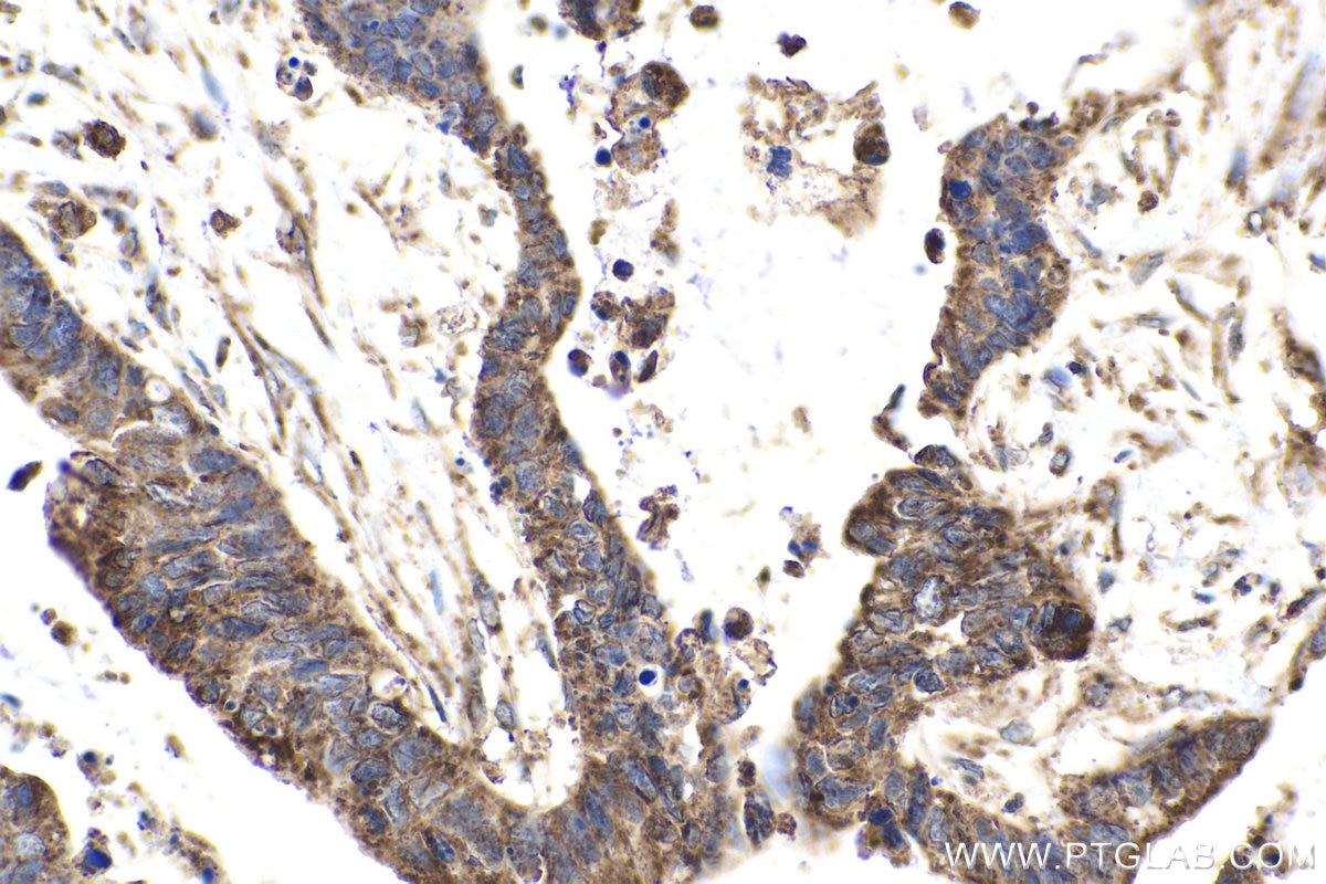 Immunohistochemical analysis of paraffin-embedded human urothelial carcinoma tissue slide using KHC1584 (GCK IHC Kit).