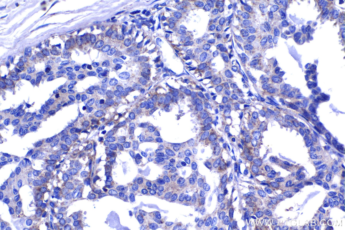 Immunohistochemical analysis of paraffin-embedded human breast cancer tissue slide using KHC1389 (GCNT2 IHC Kit).
