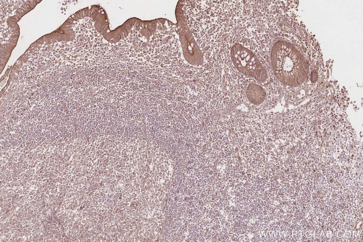Immunohistochemical analysis of paraffin-embedded human appendicitis tissue slide using KHC2828 (GCP6 IHC Kit).