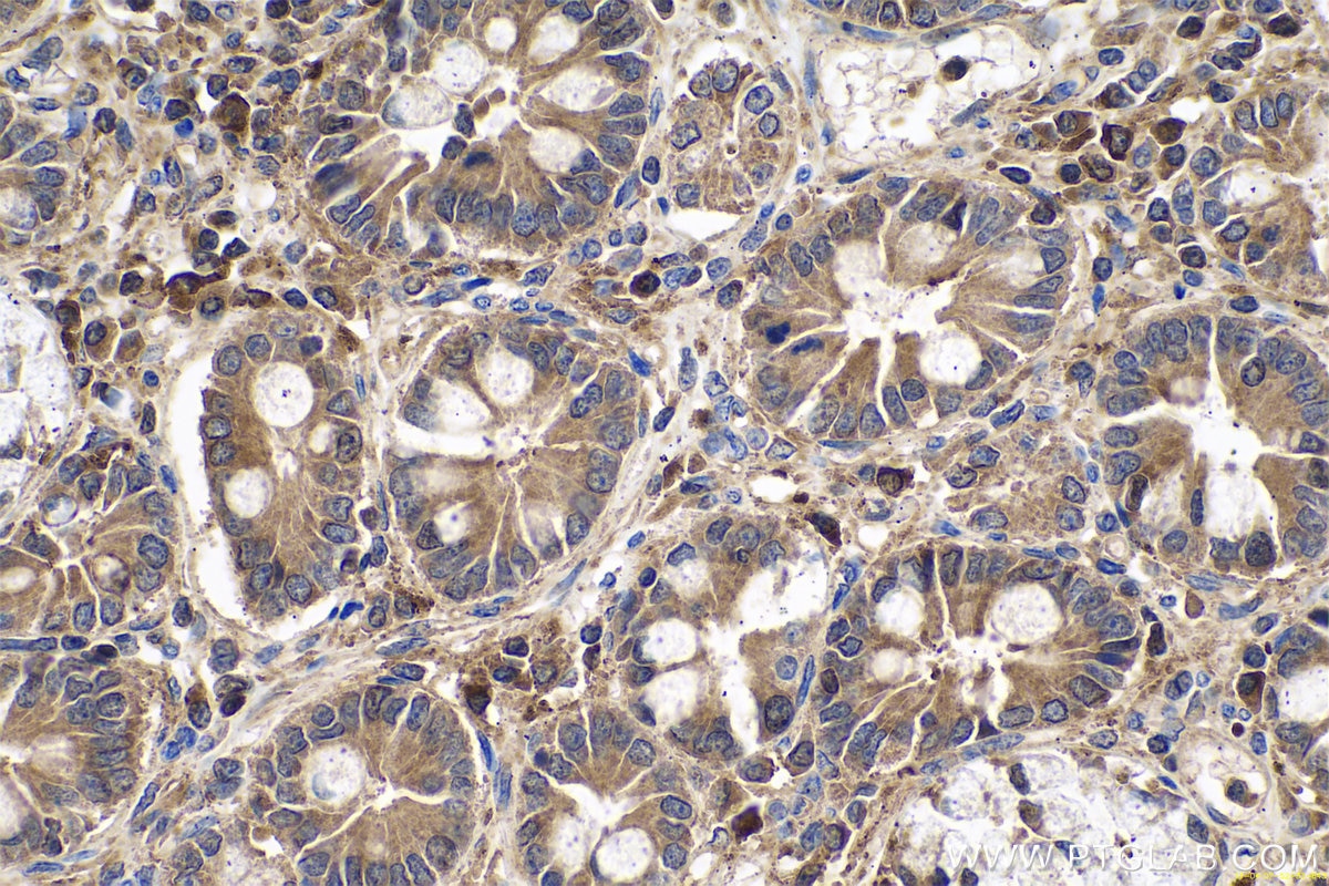 Immunohistochemical analysis of paraffin-embedded human stomach cancer tissue slide using KHC0691 (GDI2 IHC Kit).