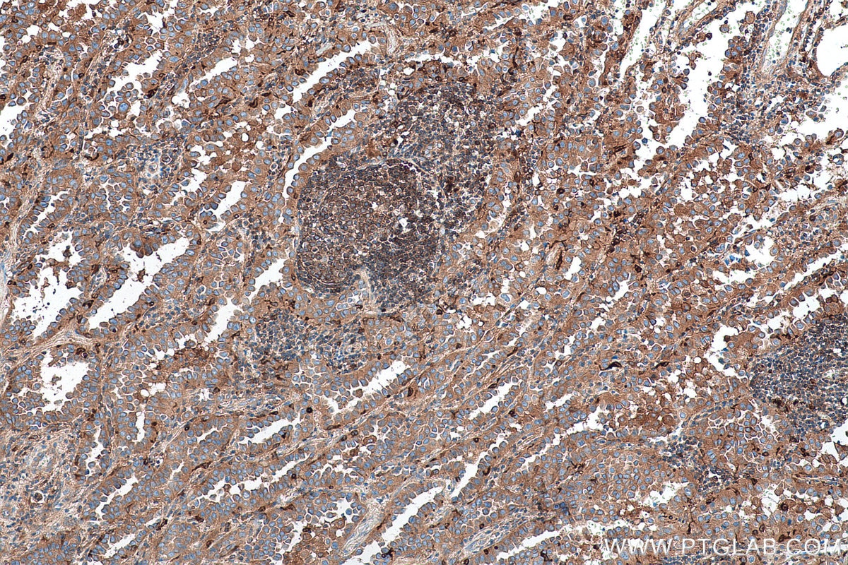 Immunohistochemical analysis of paraffin-embedded human lung cancer tissue slide using KHC0691 (GDI2 IHC Kit).