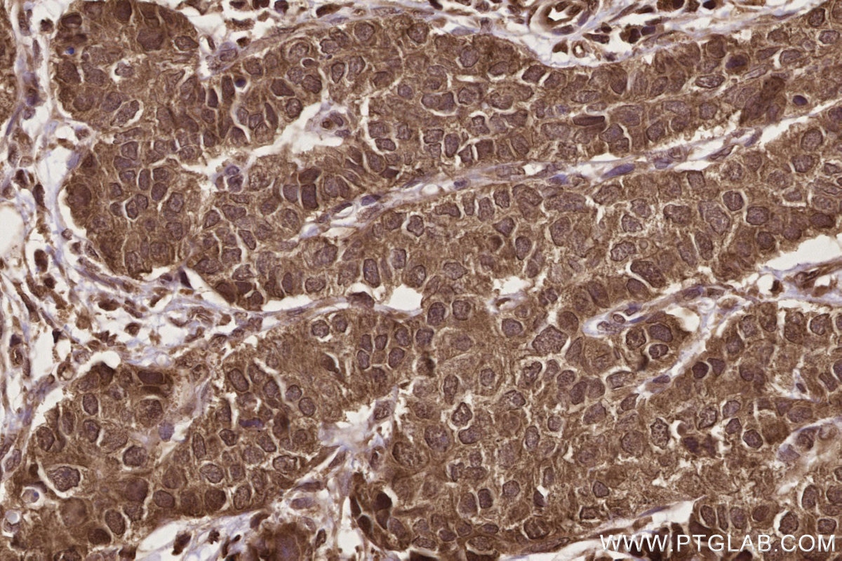 Immunohistochemical analysis of paraffin-embedded human stomach cancer tissue slide using KHC2725 (GEMIN5 IHC Kit).