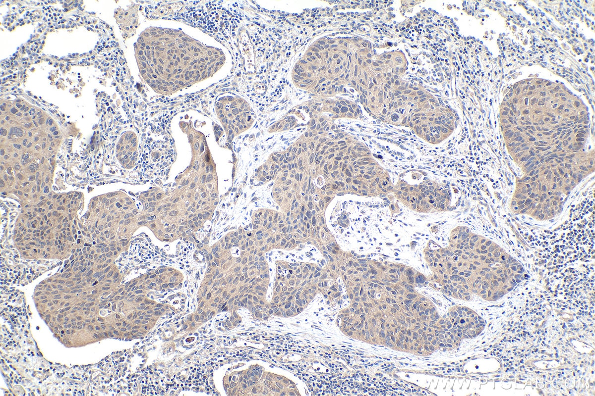 Immunohistochemical analysis of paraffin-embedded human lung cancer tissue slide using KHC1001 (GET4 IHC Kit).