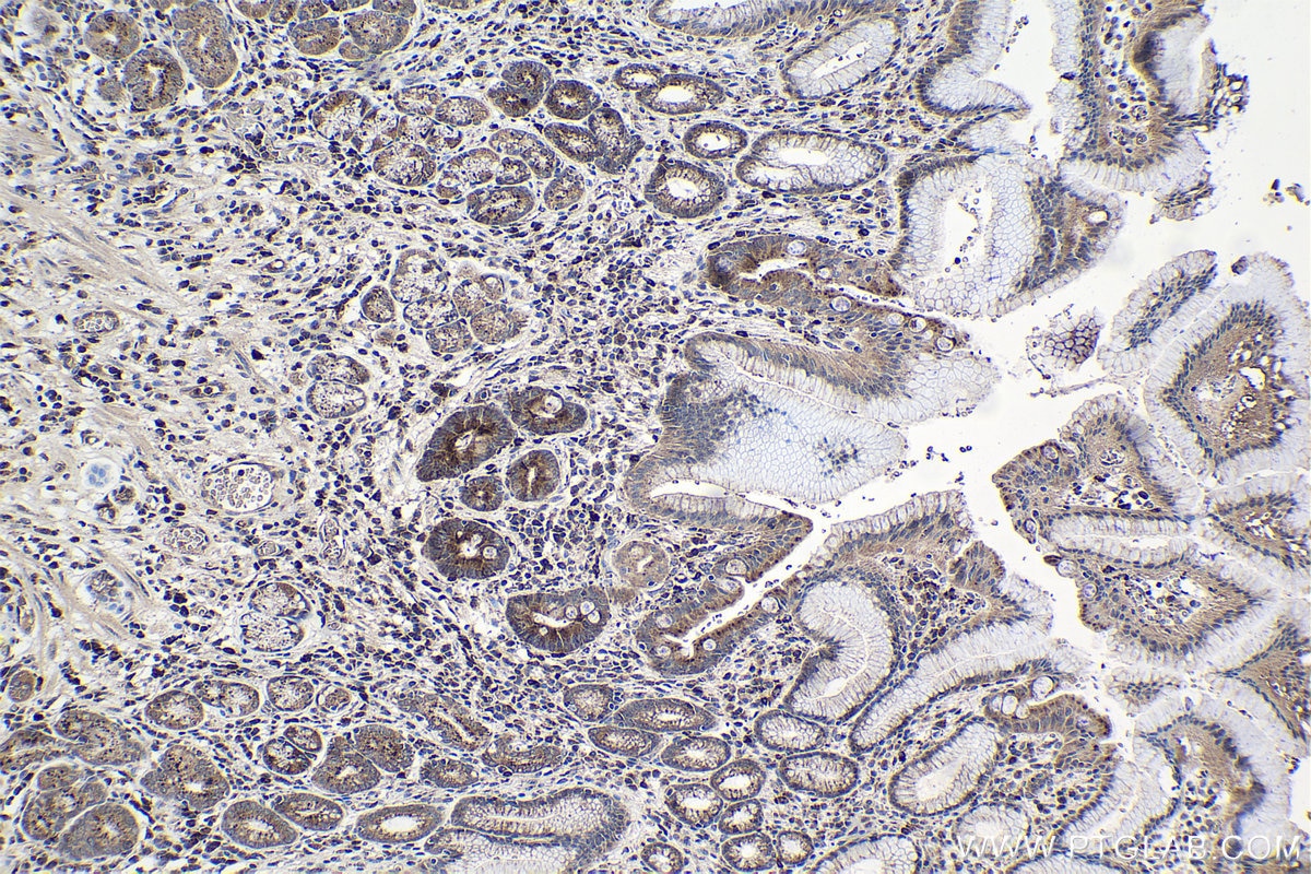 Immunohistochemical analysis of paraffin-embedded human stomach cancer tissue slide using KHC0998 (GGH IHC Kit).
