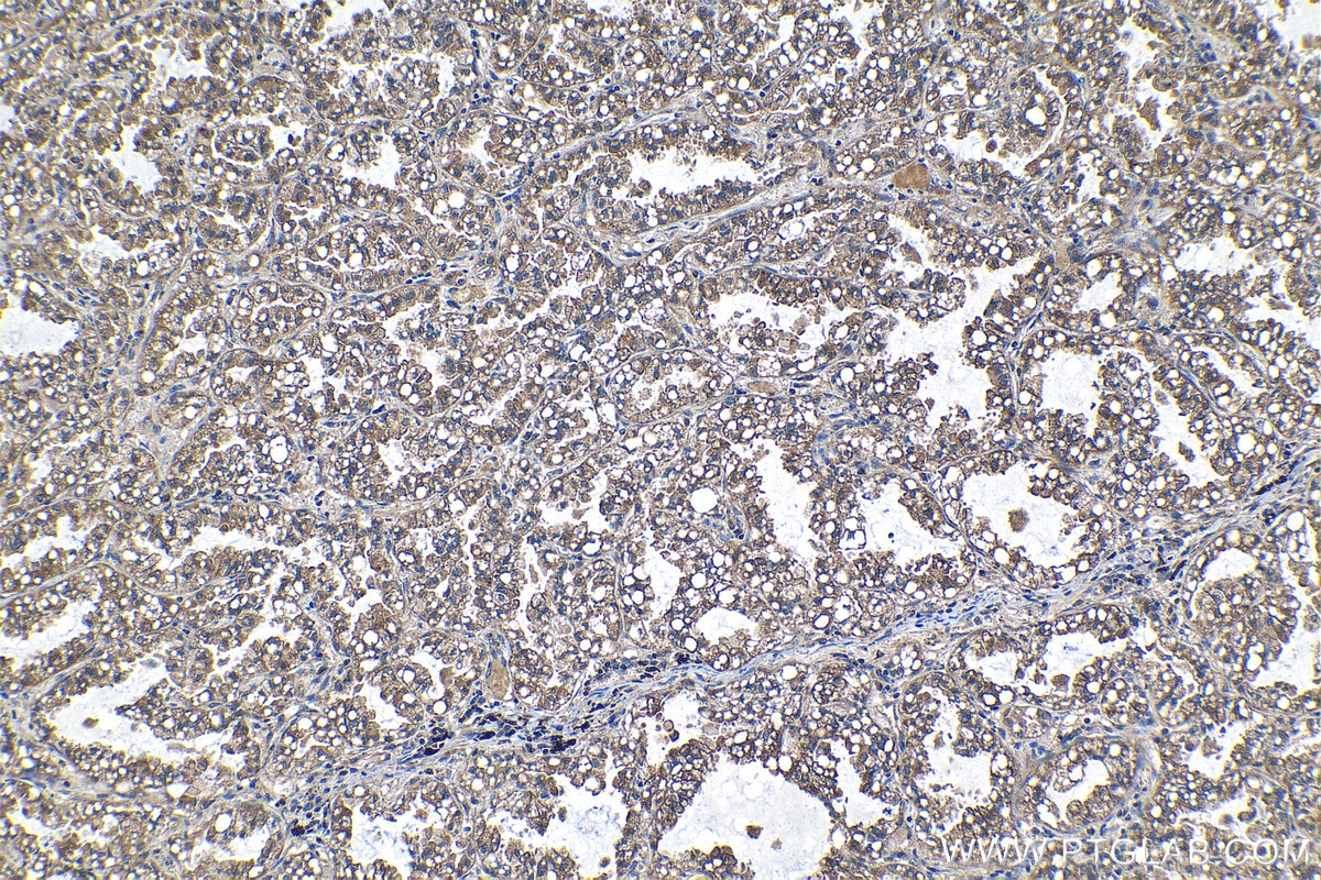 Immunohistochemical analysis of paraffin-embedded human lung cancer tissue slide using KHC1279 (GHDC IHC Kit).