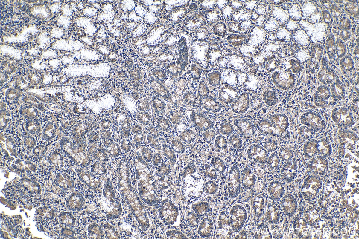Immunohistochemical analysis of paraffin-embedded human stomach cancer tissue slide using KHC1279 (GHDC IHC Kit).