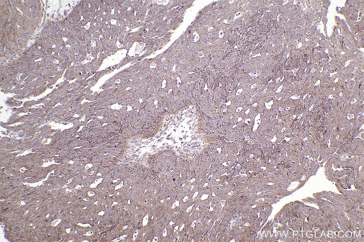 Immunohistochemical analysis of paraffin-embedded human ovary cancer tissue slide using KHC2552 (GJC2 IHC Kit).