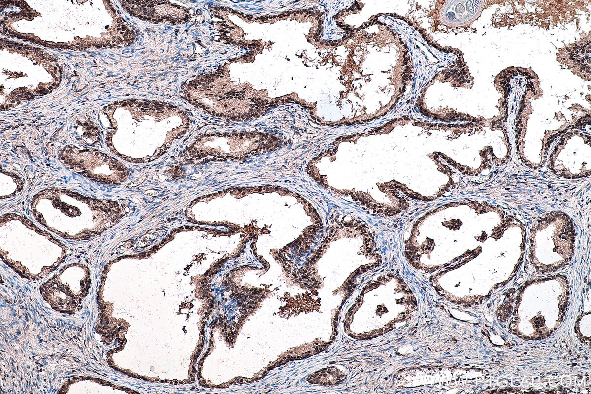 Immunohistochemical analysis of paraffin-embedded human prostate cancer tissue slide using KHC0136 (GLI2-Specific IHC Kit).
